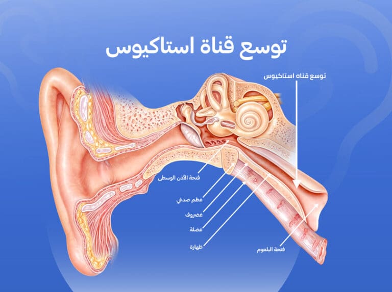 انسداد قناة استاكيوس