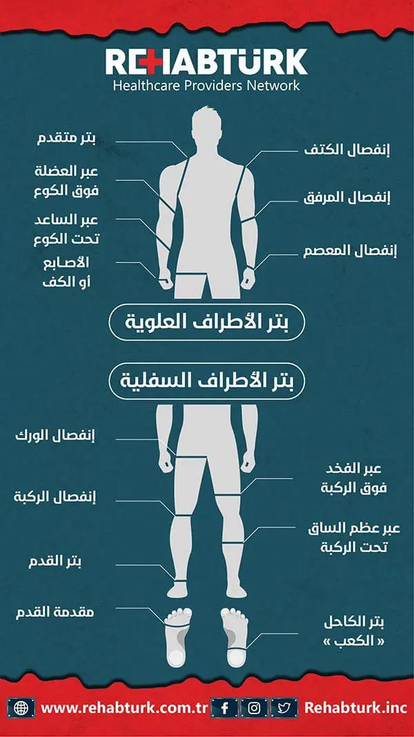 تقييم الأطراف الصناعية في تركيا 5 خطوات لاستعادة حياتك تقييم الأطراف الصناعية